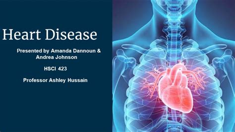 423 Heart Disease Presentation Youtube