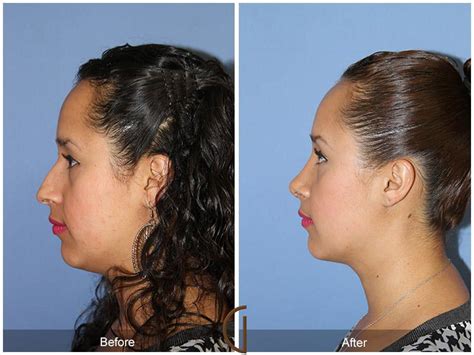 Ethnic Rhinoplasty Before And After Photos From Dr Kevin Sadati