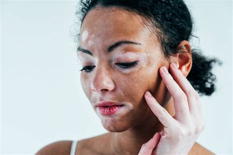 Vitiligo Treatment