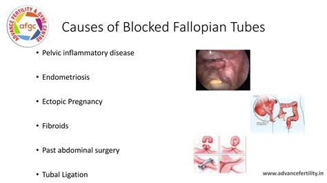 Fallopian Tube Blockage Ppt