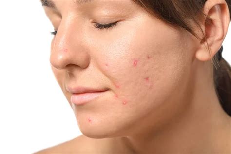 How To Remove Dark Spots Caused By Pimples Important Ideas Skin