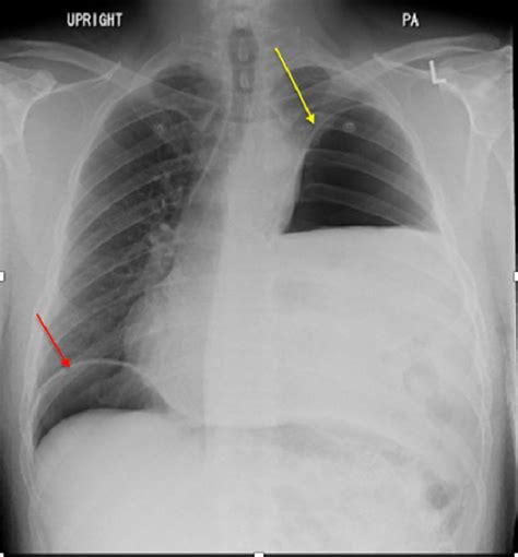 Chest X Ray Showed A Moderate Left Hemidiaphragm Elevation With Bowel Download Scientific