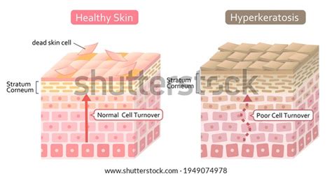 Stratum Corneum Over 302 Royalty Free Licensable Stock Vectors