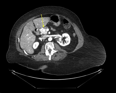 Eus Guided Radiofrequency Ablation Of A Pancreatic Neuroendocrine Tumor