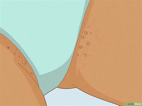 How To Get Rid Of Razor Bumps In The Bikini Area Easy Tips