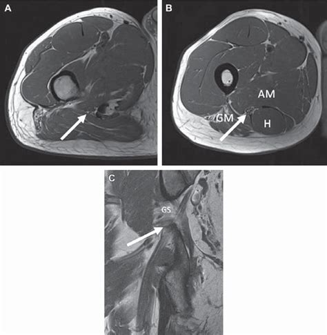 Normal Sciatic Nerve A Axial T1 Mr Images Just Below The Greater