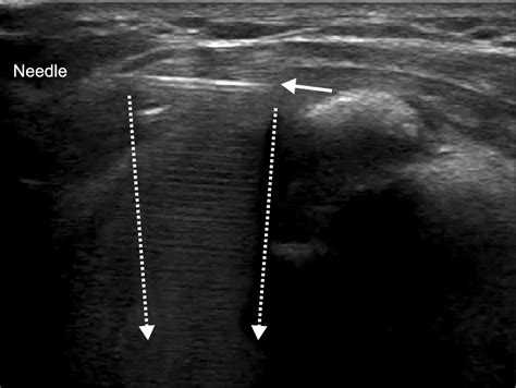 Ultrasonography Shows The Reverberation By The Needle Arrow Dotted Download Scientific