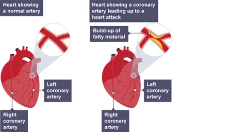 Cardiovascular Disease Flashcards Quizlet