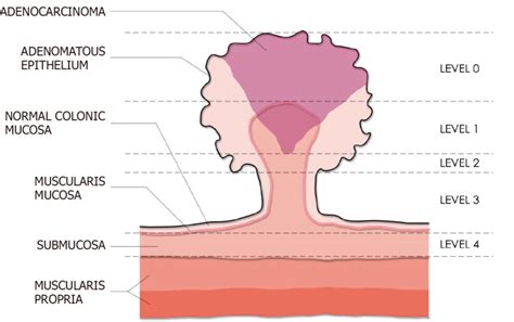 Endoscopic Management Of Colorectal Polyps From Benign To Malignant