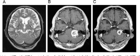 Figure 1 From Contralateral Hearing Loss After Acoustic Neuroma Surgery Semantic Scholar