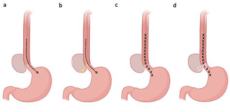 Cartoon Representing The Technique Of Diverticular Per Oral Endoscopic