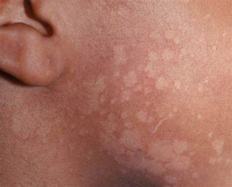 Tinea Versicolor Treatment Pictures Causes Symptoms Prevention Porn