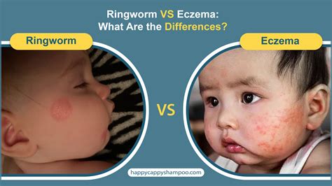 Ringworm VS Eczema: What Are the Differences? - Happy Cappy