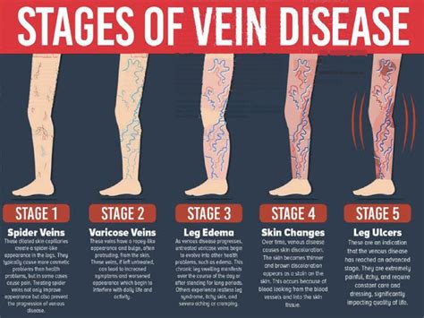 VENOUS DISEASE It's More Than Just Varicose Veins • Southwest Florida's ...