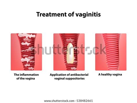 Treatment Vaginitis Suppositories Inflammation Vagina Infographics