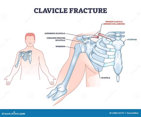 Clavicle Fracture With Broken Collarbone Vector Illustration Medical