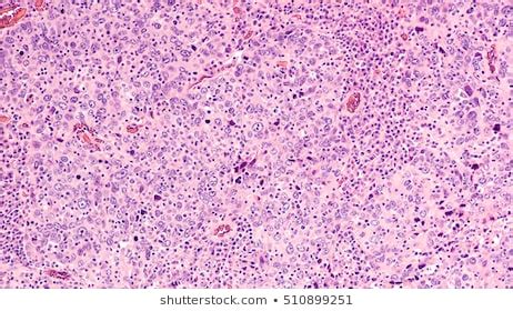 Histopathology Liver Abscess Light Micrograph Hematoxylin Foto Stok