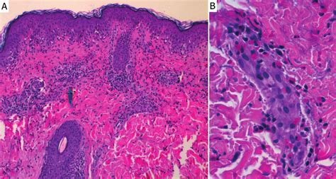 Histopathology Of A Lesional Skin Biopsy Specimen A A Superficial