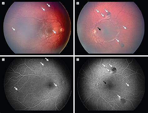 Epiretinal Membrane And Retinal Pigment Epithelial Lesions In A Young