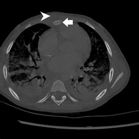 Chest Computed Tomography White Arrow Indicates Osteomyelitis Of The