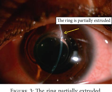 Figure 1 From Clinical Study Femtosecond Laser Implantation Of A 355