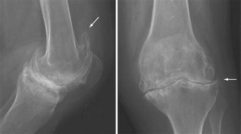 Rheumatoid Arthritis X Ray Knee