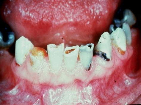 Radiographic Caries Diagnosis Ppt