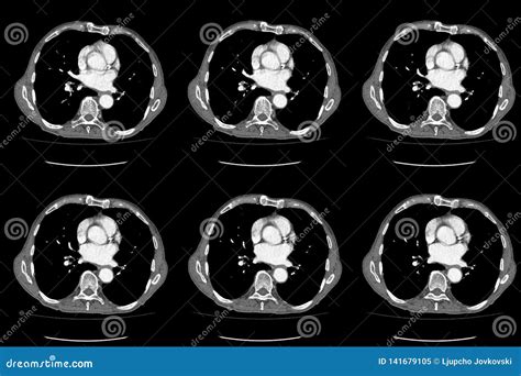 Computed Tomography Ct Whole Abdomen In Axial Part Nine Stock Image