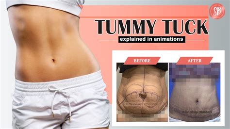 How To Reduce Belly Fat Tummy Tuck Surgery Youtube