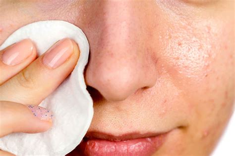 Home Remedies for Blackheads | Reader's Digest