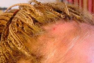 Qu Es La Alopecia Por Tracci N Tratamiento Causas Y S Ntomas