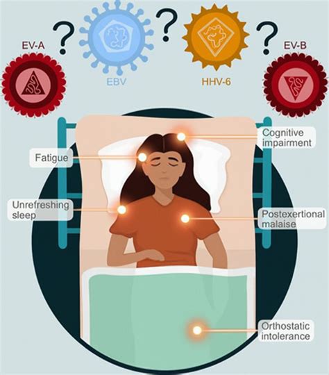 Chronic Fatigue Syndrome Causes Symptoms Diagnosis And Treatment