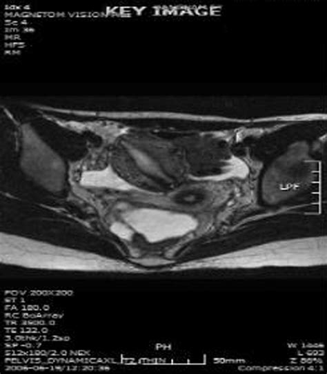 A Case Report Metroplasty Of A Noncommunication Rudimentary Uterine