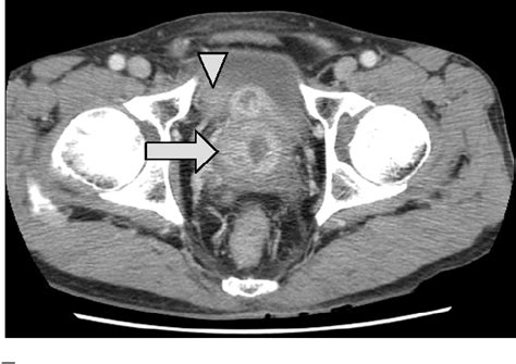 [pdf] Prostatic Stromal Tumor Of Uncertain Malignant Potential Stump