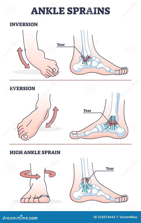 Entorse De Cheville Situations Avec Inversion Et Version Plan De