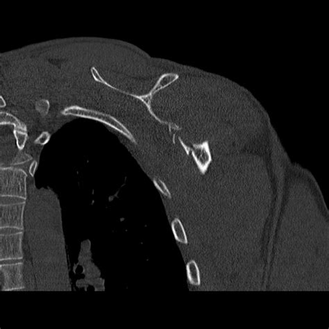 Scapular Fracture Image Radiopaedia Org