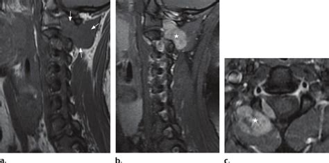 Tgct Sagittal T1 Weighted A Sagittal Contrast Enhanced T1 Weighted