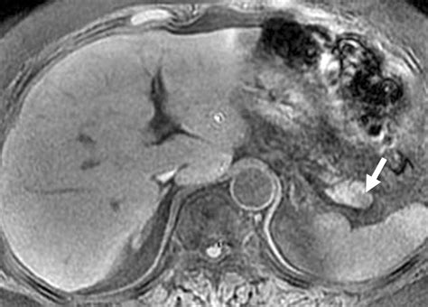 Contrast Enhanced Sonography Of Intrapancreatic Accessory Spleen In Six