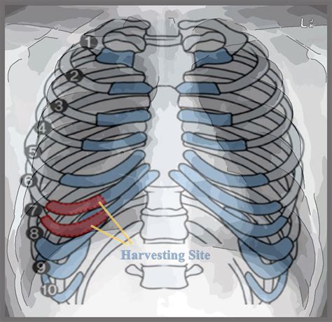 Costal Cartilage Injury