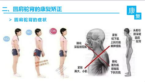 圆肩驼背矫正的视频教程 知乎