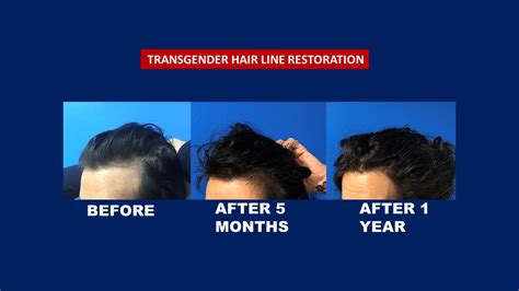 Transgender Hair Transplant Before After Hair Transplant Centre Malaysia