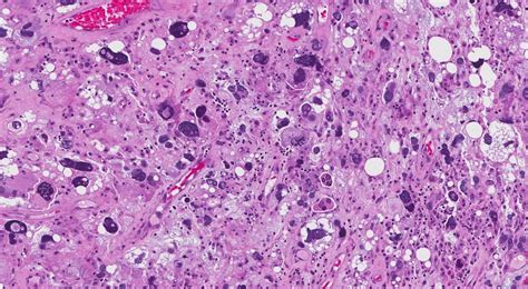 Pleomorphic Liposarcoma Atlas Of Pathology