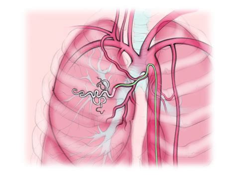 Bronchial Artery Embolization The Interventional Initiative