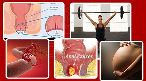 Anal Fissures Chakrayog