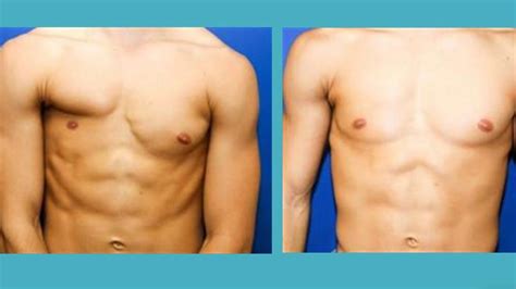 Chest Surgery Good Results Youtube