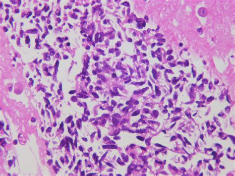 Small Cell Carcinoma Fna Cell Block Predominantly Spindle… Flickr