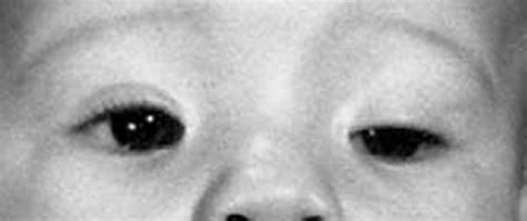Blepharophimosis, ptosis, and epicanthus inversus syndrome: MedlinePlus ...