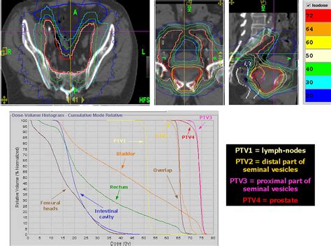 Significant Reduction Of Acute Toxicity Following Pelvic Irradiation With Helical Tomotherapy In