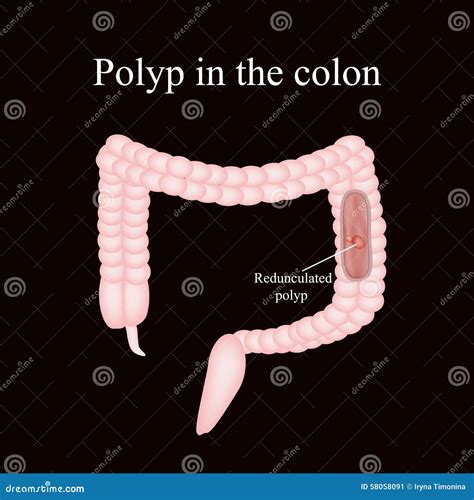 Polyp In The Intestine Polyp In The Colon Stock Vector Illustration