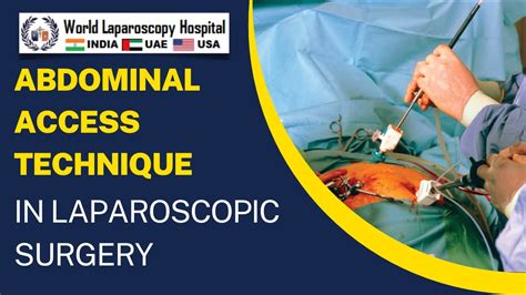 Abdominal Access Technique In Laparoscopic Surgery YouTube